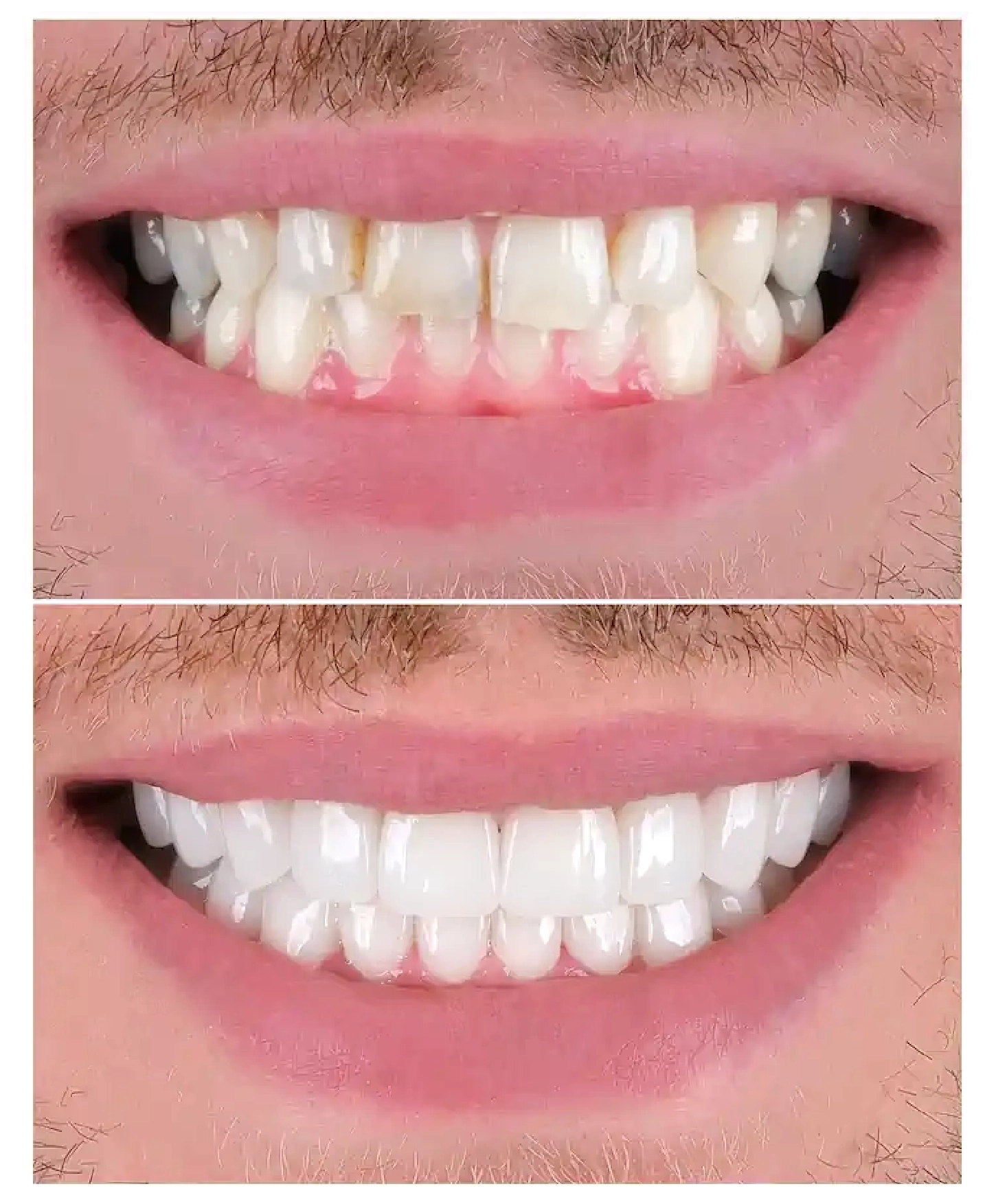 After - Aligned Smile